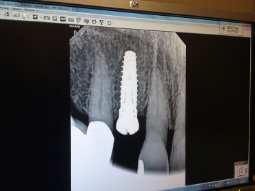 3D Imaging Technologies Realize Customized Dental Implant