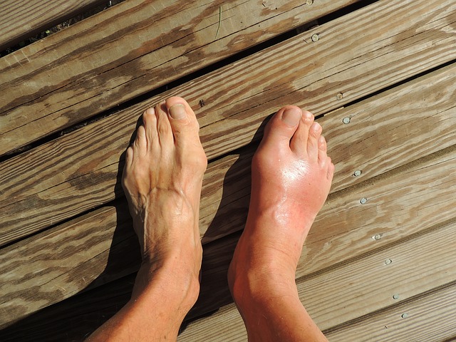 Middle-aged Men More Prone to Gout, and Significant Medical Costs