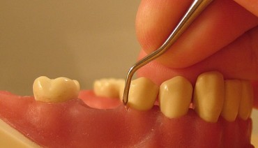 Periodontal Patient Numbers Rise Rapidly after Insurance Coverage of Scaling