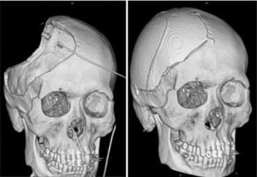 First Successful 3D Printed Skull Transplant in Gangwon-do