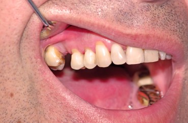 Periodontal Diseases Could Lead to Impotence