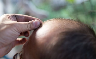 Nearly Half of Korean Men Suffer from Hair Loss: Poll