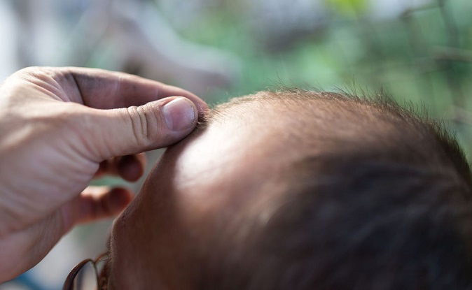 Hair Loss Patients Jump by 10 pct Over 4 Years