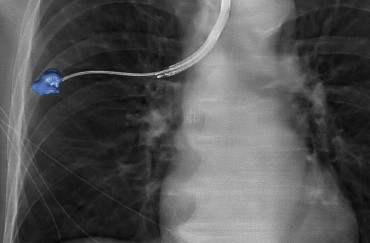 Radboud University Medical Center Study Sets New Milestone with 90% Diagnostic Accuracy of lung Nodules Suspected of Cancer Using Philips Technology for Bronchoscopic Procedures