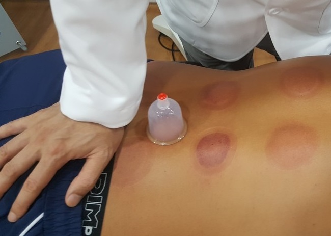 This photo provided by the Gwangju Association of Korean Medicine shows a Korean medicine doctor performing cupping therapy.