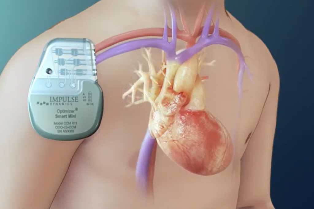 Impulse Dynamics is dedicated to advancing the treatment of heart failure for patients and the healthcare providers who care for them. (Image from the company YouTube channel)