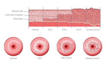 Amplexd Therapeutics, Innovating to Revolutionize the Future of Non-Invasive HPV-induced Cervical Intraepithelial Neoplasia (CIN) Treatments for the Prevention of Cervical Cancer: Developed by Women for Women