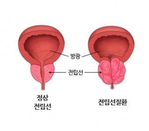 The market for benign prostatic hyperplasia (BPH) medications is projected to reach 200 billion won by 2026. (Image courtesy of Asan Hospital)