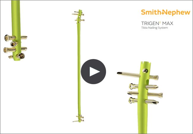 Smith+Nephew’s new TRIGEN™ MAX Tibia Nailing System brings ‘next-level nailing’ to trauma surgeons repairing tibial fractures