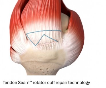 Smith+Nephew completes acquisition of Integrity Orthopaedics; establishes unrivalled portfolio for shoulder repair