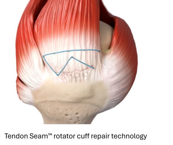 tendon-seam-1